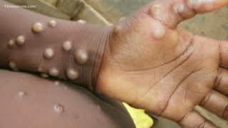 What you need to know about the monkeypox outbreak [upl. by Uta246]