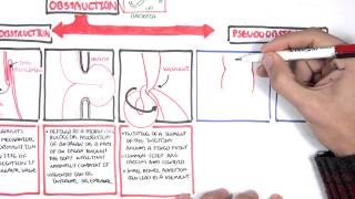 Bowel Obstruction  Causes and Pathophysiology [upl. by Kala]