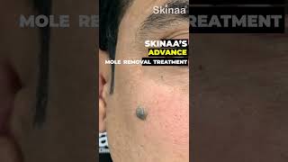 Best Mole Removal Treatment at Skinaa Clinic Viral shortsviral [upl. by Mae]