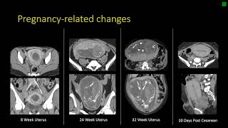 Gynecologic Radiology Anatomy [upl. by Bruni909]