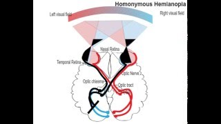 homonemous hemianopia [upl. by French256]