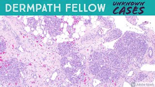 Dermpath Fellow Slide Session Kaposiform hemangioendothelioma plexiform fibrohistiocytic tumor etc [upl. by Cirre]