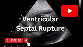 Ventricular Septal Rupture  Echo  VSR [upl. by Kaspar]