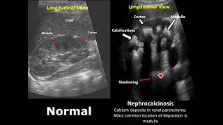 Kidney Ureter and Bladder KUB Ultrasound Normal Vs Abnormal Image Appearances Comparison [upl. by Hcone]