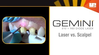 Gemini Clinical – Gingivectomy [upl. by Duky]