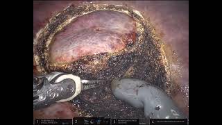 Robotic Microwave Ablation  Partial hepatectomy [upl. by Hgiellek]