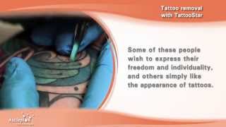 Tattoo removal with the TattooStar qswitched laser by Asclepion [upl. by Clemens440]