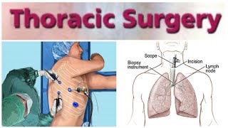 Thoracic Surgery 1  Bronchogenic Carcinoma [upl. by Adaynek]