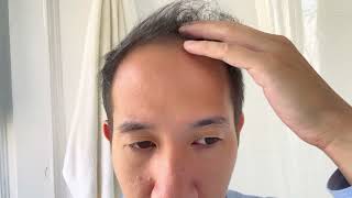 Early results after 3 months using HIMs topical minoxidil and finasteride as a 40 year old asian man [upl. by Kcorb]