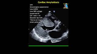 Cardiac Amyloidosis [upl. by Dnalerb590]