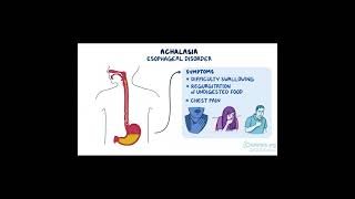 Achalasia A Disorder of the Esophagus health [upl. by Rosenthal]