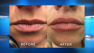 New Lip Filler Results [upl. by Ecirted]