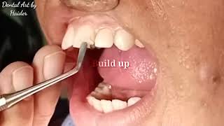 Light Cure Composite Filling  Front teeth filling  Composite Filling Procedure [upl. by Trevor183]