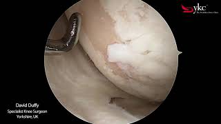 What Does Arthritis of The Knee Joint Look Like [upl. by Yrrat592]