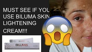 DO NOT use BILUMA without watching this video [upl. by Leuname872]