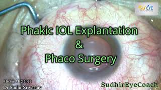 Phakic IOLICL Explantation amp Phaco surgery with IOL Implantation [upl. by Eniloj]