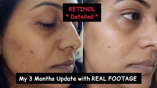 RETINOL  REAL FOOTAGE Of My Consistent 3 Month Experience of Using RETINOL  💯 Honest [upl. by Yeldoow]