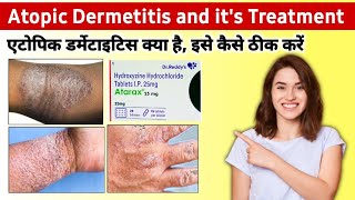 Atopic dermatitis treatment in hindi  hydralazine 25 mg tablet  Atarax injection  baby dermatitis [upl. by Stoat]