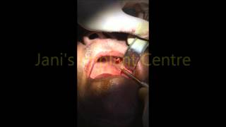 TUBEROPTERYGOID STRATEGIC BASAL IMPLANT DR MEHUL D JANI [upl. by Chapa719]