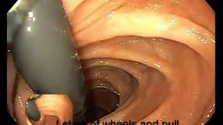 Right Colon Retroflexion [upl. by Arutek]