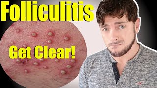 Folliculitis Skin Bumps  Get Clear Skin and Scalp  Causes and Cures [upl. by Novit]