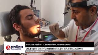 Burun Ameliyatı Sonrası Tampon ÇıkarılmasıYrd Doc Dr Ahmet Hamdi Kepekçi [upl. by Ednargel]