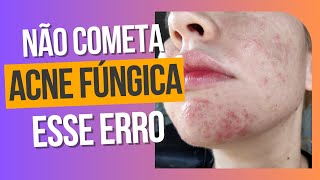 Escolhendo o melhor tratamento para acne fúngica  Comparação Peróxido de Benzoíla e Ácido Azelaico [upl. by Kari]