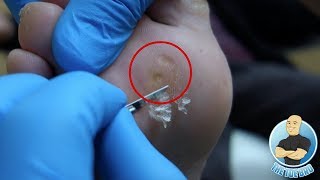 Removal of Painful Foot Callus and Corns for Diabetic Patient 15 Years of Suffering [upl. by Hsac]