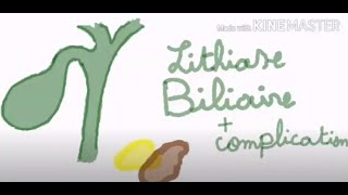 lithiase biliare et ses complications [upl. by Eads]