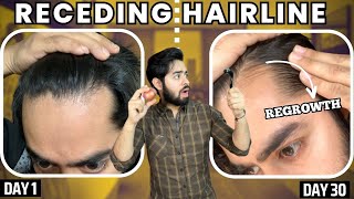 सिर्फ 1 महीने मैं RECEDING HAIRLINE REGROW करो  30 days HAIRLINE REGROWTH challenge [upl. by Alraep]