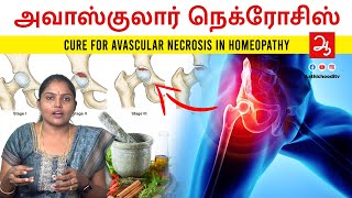 ரத்தஓட்டம் தடைபடுவதால் வரும் Avascular necrosis loss of blood supply to bone Avascular necrosis AVN [upl. by Leamse]