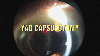 YAG CAPSULOTOMY TAKE A LOOK TO THE TECHNIQUE [upl. by Kinna]