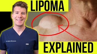 Doctor explains LIPOMA  Symptoms clinical photos and treatment [upl. by Ecile343]