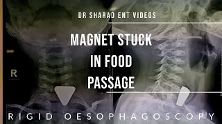 RIGID OESOPHAGOSCOPY  FOREIGN BODY IN OESOPHAGUS  Dr Sharad ENT Videos  youtubevideo surgery [upl. by Ainer]