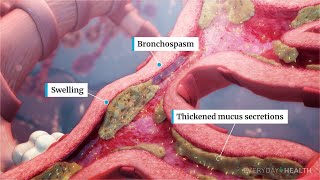 What Is Severe Asthma [upl. by Atileda]