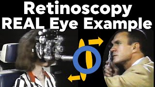 Retinoscopy Real Eye Full Example Plus Cylinder with Phoropter Refraction of the Eye [upl. by Halvaard]