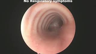 Effects of Posterior Tracheopexy for treatment of tracheomalacia [upl. by Samtsirhc]