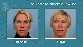 Sculptra filler for cheeks and jawline [upl. by Auginahs988]