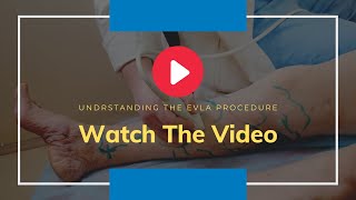 Say Goodbye to Varicose Veins EVLT Minimally Invasive Surgery Explained [upl. by Napoleon]