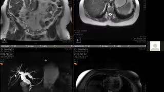 Choledochal cyst with abnormal pancreatobiliary junction  Dr Nelly Tan [upl. by Hidie]