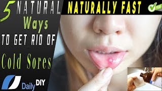 How To Get Rid Of Cold Sore Naturally Fast  Cold Sore Remedies  Natural Cold Sores Treatment [upl. by Seraphina]