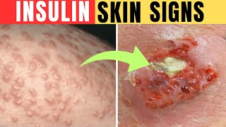 Top 7 Skin Signs of Insulin Resistance [upl. by Bradlee246]