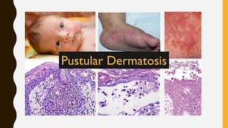 6 Pustular Dermatosis [upl. by Seuqram862]