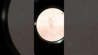 How Schistosoma Haematobium Ova in Urine Microscopy appears [upl. by Roxy868]