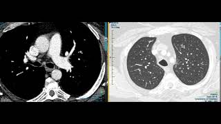 Right upper lobe lesion with hilar lymph node [upl. by Aibun]