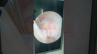 ACL ganglion cystkeyhole surgery arthroscopic decompression kneearthroscopy acl ganglioncyst [upl. by Atik227]