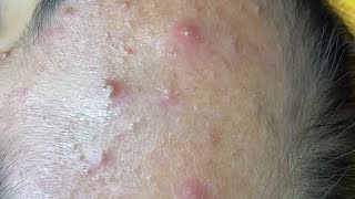 inflamed forehead and cheek acne  dermacool 0217 [upl. by Terces]