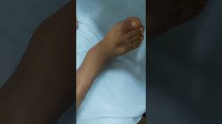 Pitting edema  DCLD patient clinicalexamination hospital doctor [upl. by Leilamag502]