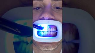 Transformation of Yellow Teeth teethwhitening [upl. by Backer]