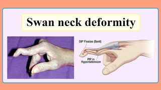 swan neck deformity [upl. by Sibley]